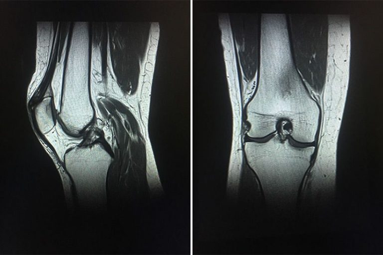МРТ колена - изображение