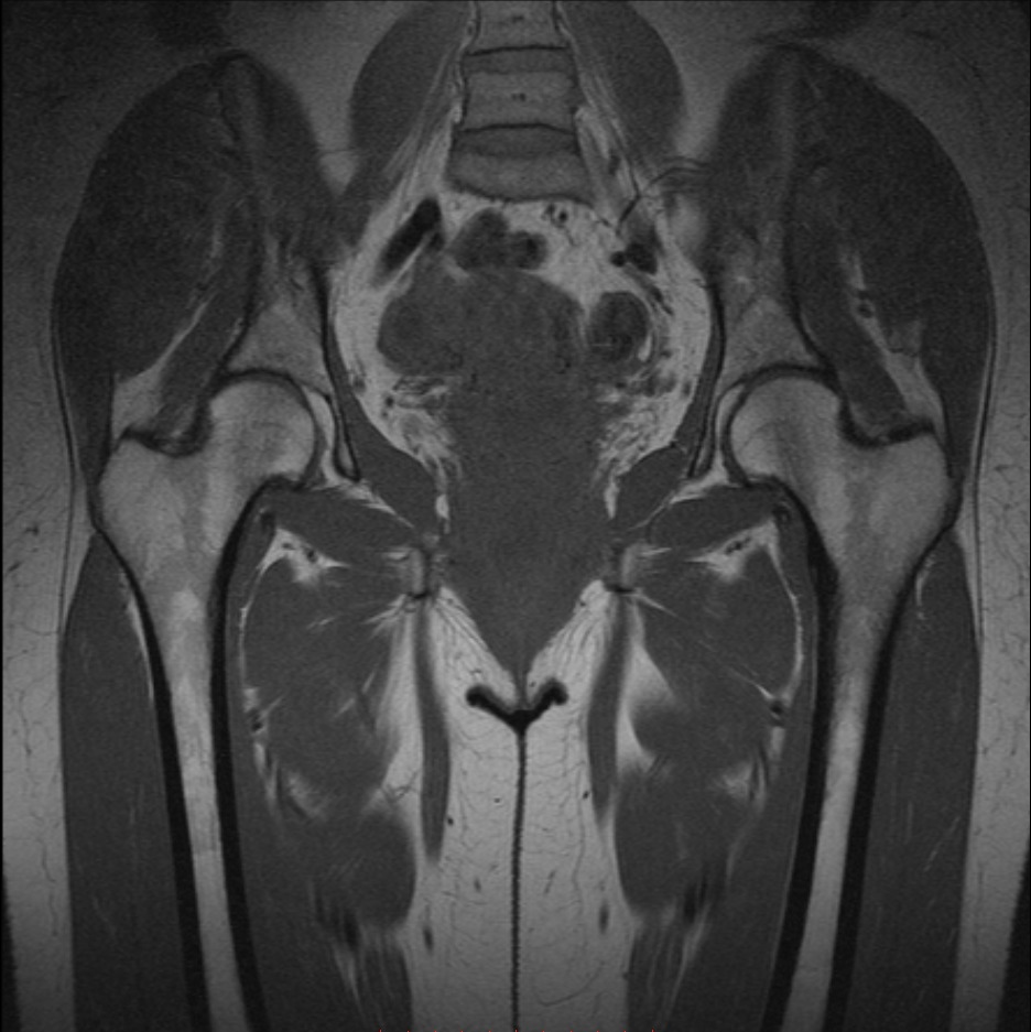 Что покажет мрт тазобедренного сустава у женщин. Коксартроз тазобедренного мрт. Дисплазия тазобедренных суставов мрт. Патология тазобедренного сустава на мрт. Мрт тазобедренного сустава норма.